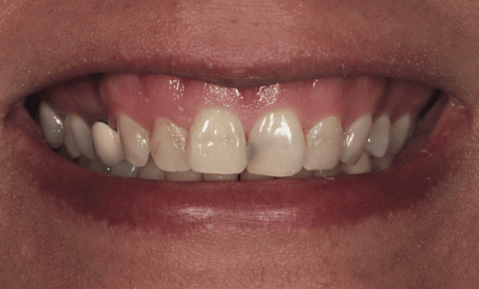 Before - Bond Dental London