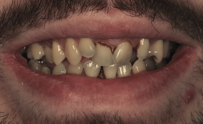 Before - Bond Dental London