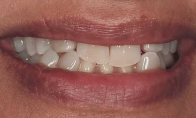 Before - Bond Dental London