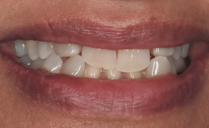 Before - Bond Dental London