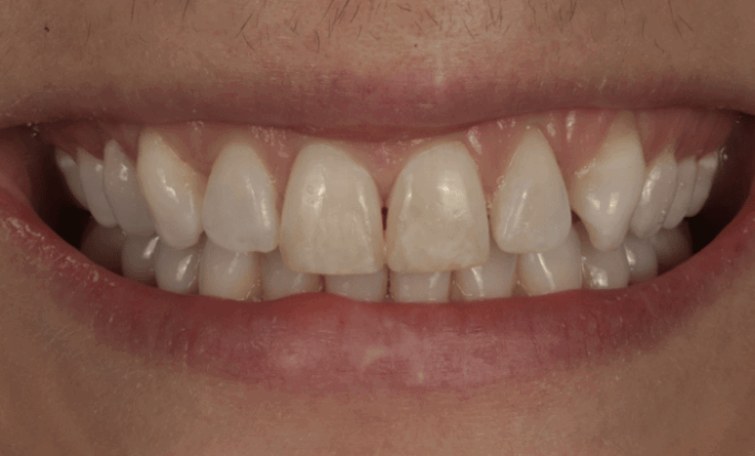 Before - Bond Dental London