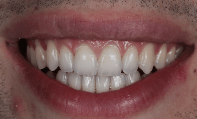 After -Bond Dental London