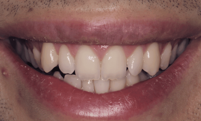 Before - Bond Dental London
