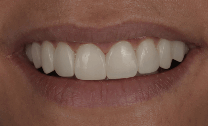 After -Bond Dental London