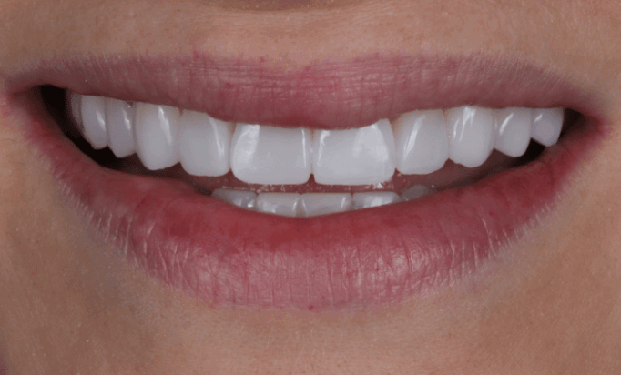 After -Bond Dental London