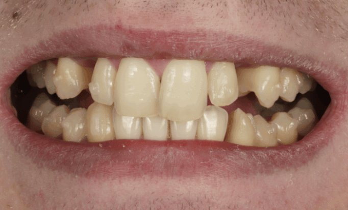 Before - Bond Dental London