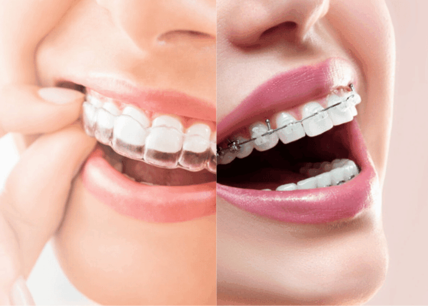 Blog Inner - Bond Dental London